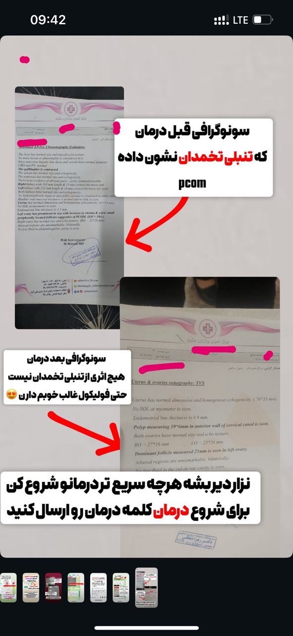 رضایت از درمان تنبلی تخمدان